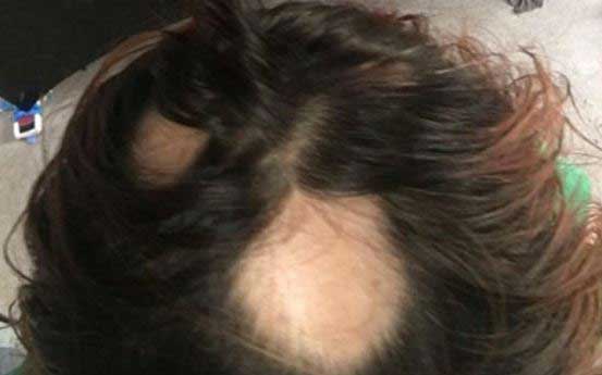 Suit Alleges Wen By Chaz Dean Products Lead To Hair Loss Your
