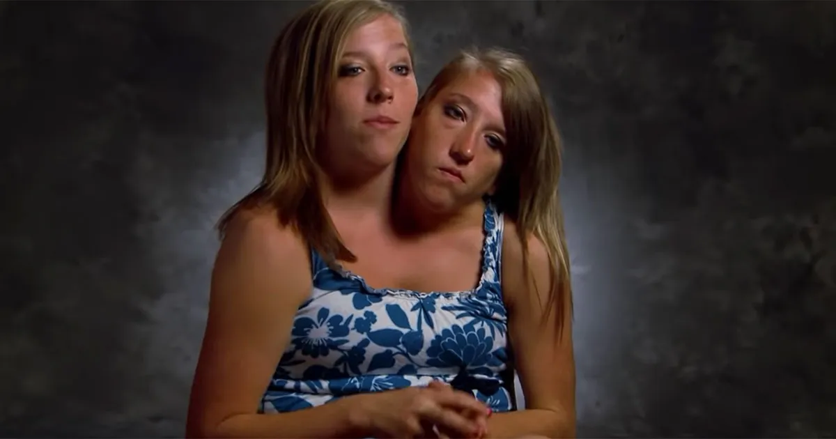 Conjoined Twins Abby And Brittany Life Story And Where They Are Now